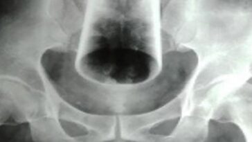 Man undergoes surgery after inserting water glass in his rectum and leaving it there for 3-days